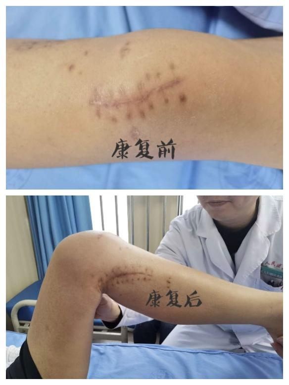 骨折6.png